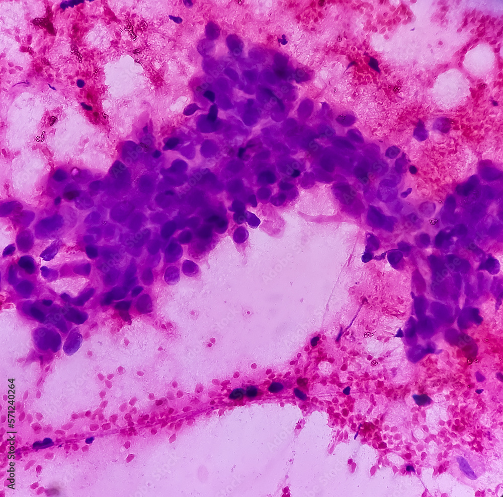 breast-lump-fna-cytology-proliferative-breast-disease-with-atypia