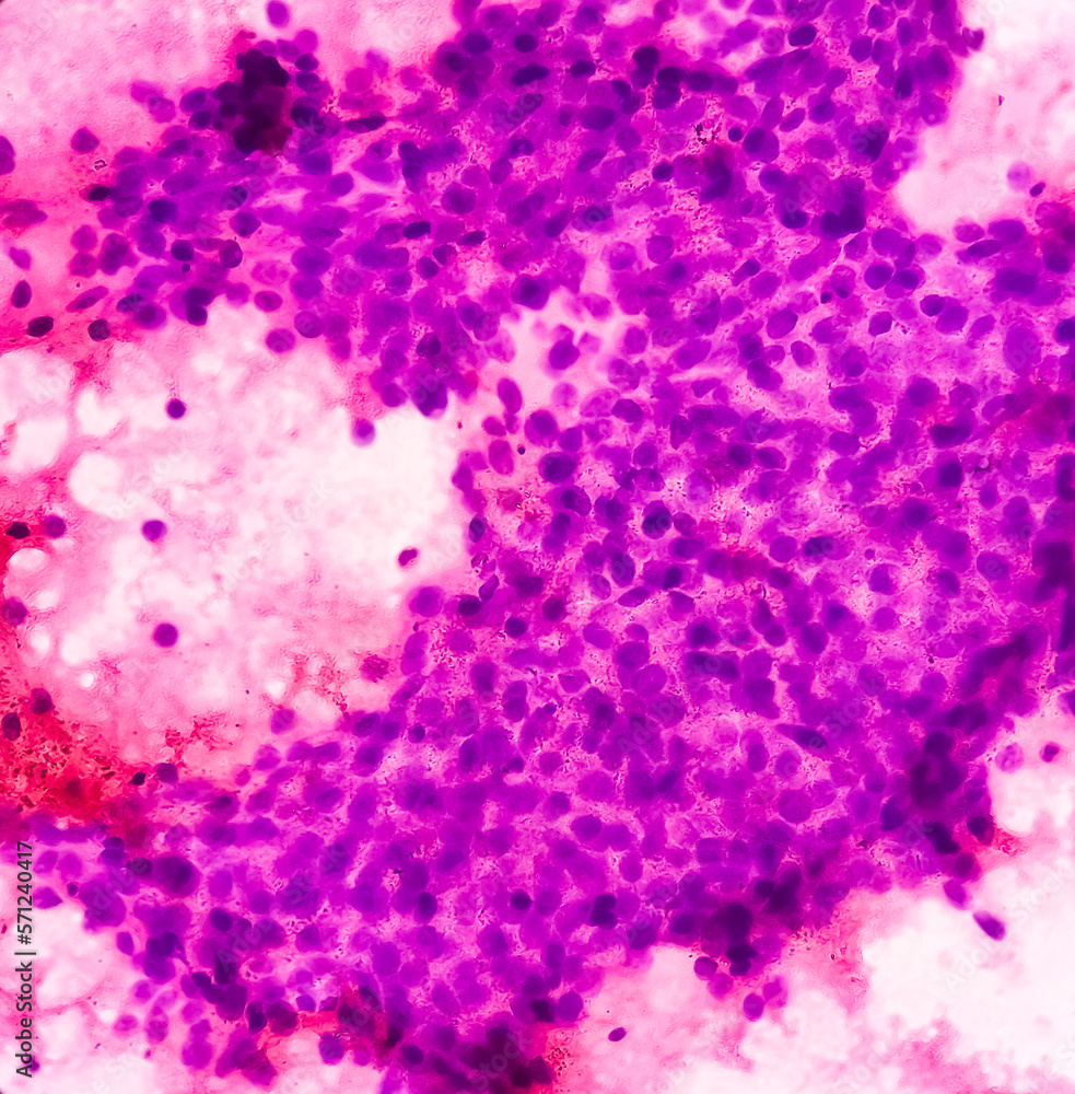 Breast lump(FNA Cytology): Proliferative breast disease with atypia, show cellular material background shows blood. Atypical hyperplasia.