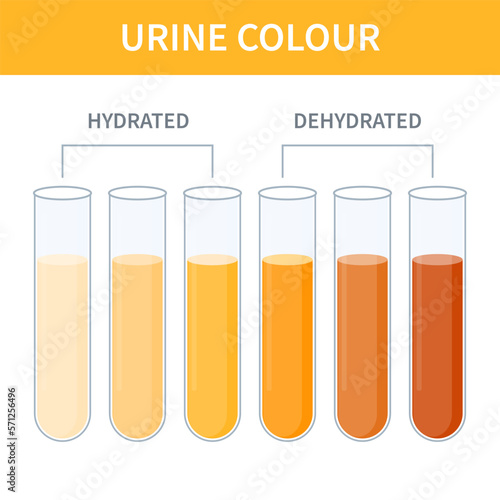 Urine colour chart. Hydration and dehydration level diagram. Medical urinal test kit for urinary tract infection research. Containers with yellow to brown pee for urinalysis. Vector illustration.