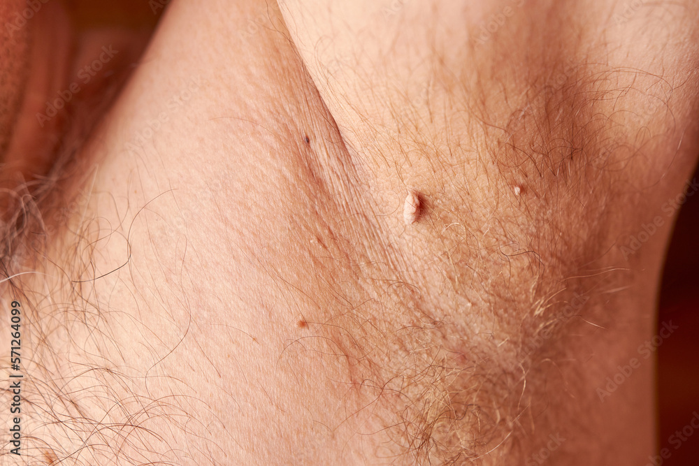Fototapeta premium Large papilloma under the armpit of a man. Skin disease. Skin care.