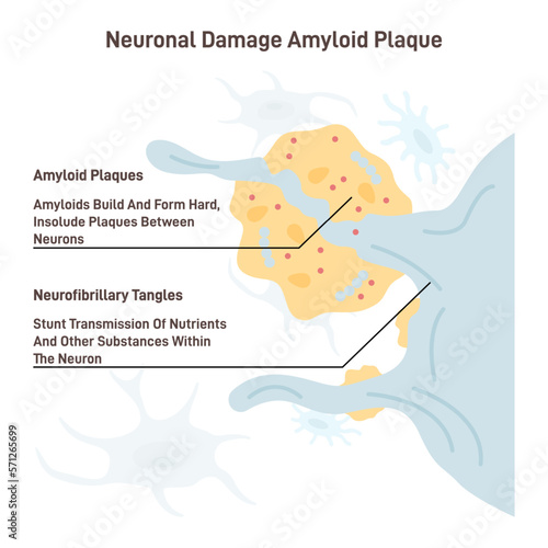 Alzheimer's disease. Human brain structure affected by dementia