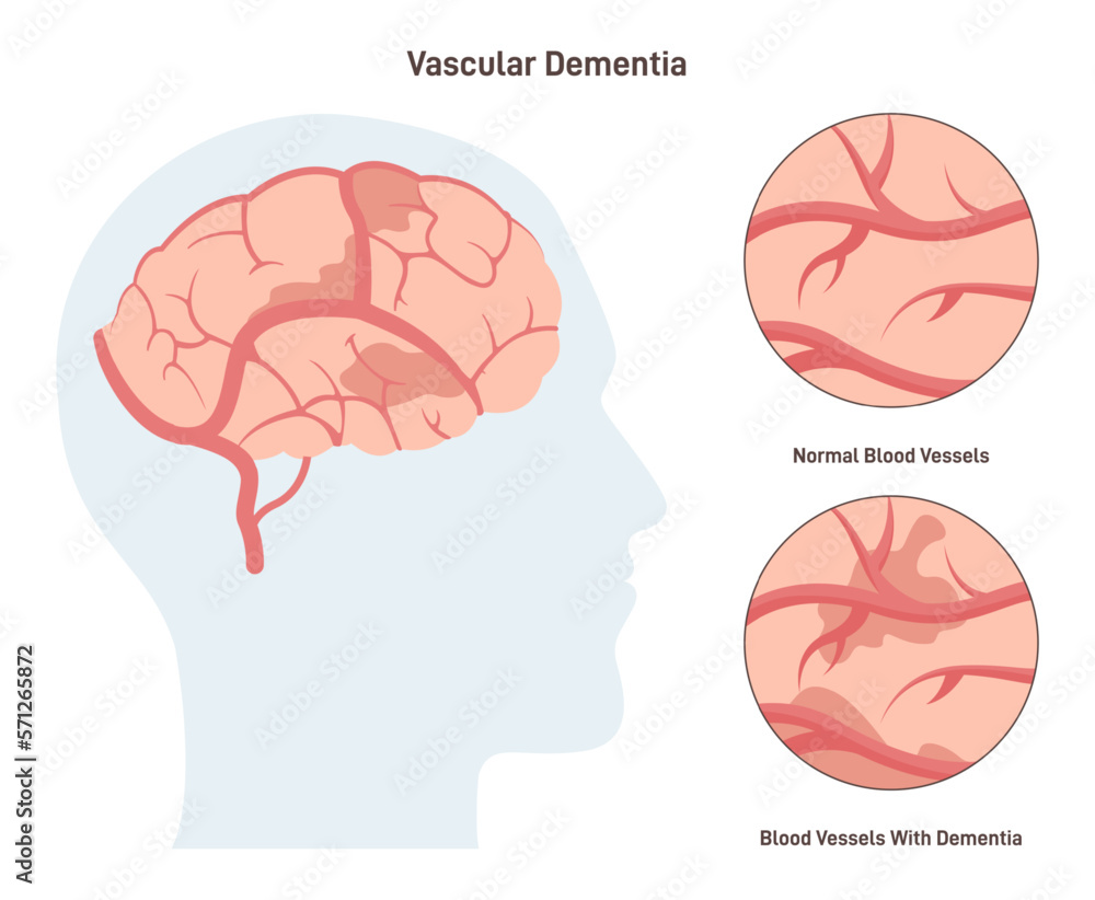 Vascular dementia. Common type of dementia caused by reduced blood