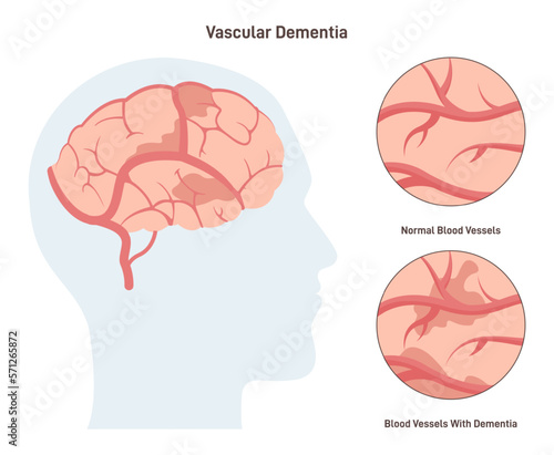 Vascular dementia. Common type of dementia caused by reduced blood