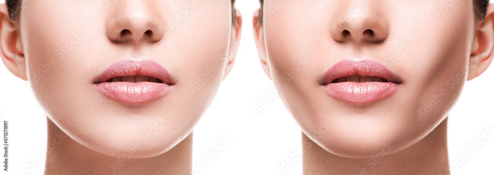 Female face comparison after buccal fat extraction plastic surgery Female face comparison after buccal fat extraction plastic surgery