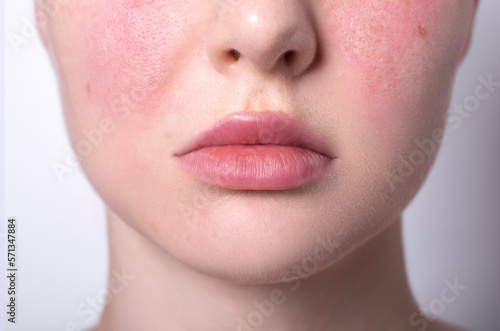 rosacea couperose redness skin, red spots on cheeks, young woman with sensitive skin, patient face close-up 