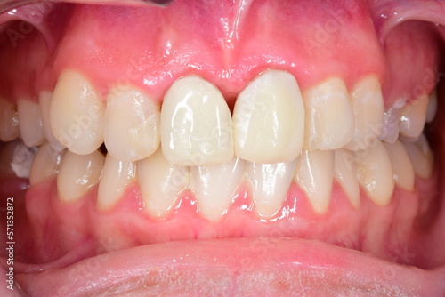 Fixed prosthetic crowns in central incisors. Frontal view of maxillary arch incisor and canine teeth, gum inflammatory. Cheeks and lips retracted with cheek retractor
