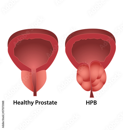 Prostate - Próstata photo