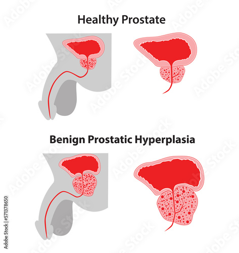 Prostate - Próstata 