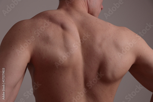 Anabolic steroids and skin problems. Sport man with pimples back acne