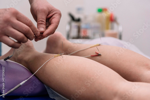 electroacupuncture with the needle connection machine. Electrical stimulation in physiotherapy in the physiotherapy center. photo