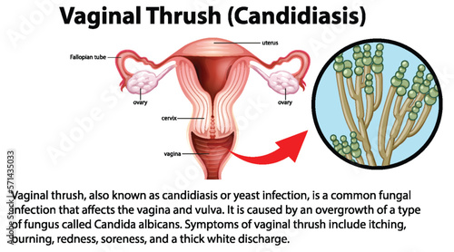 Vaginal Thrush (Candidiasis) infographic with explanation
