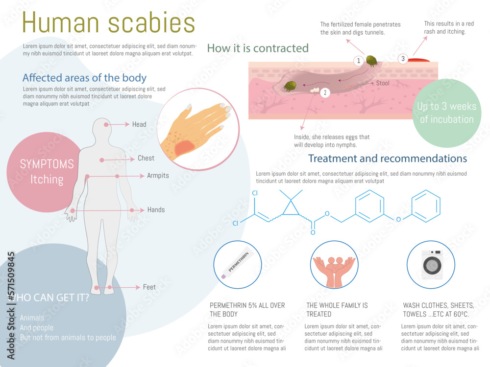 Scabies in humans infographic. How it spreads, treatment, symptoms with
