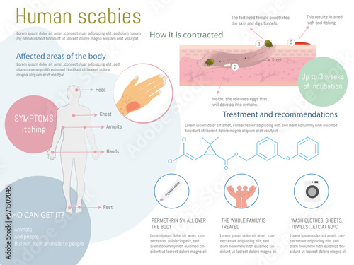 Scabies in humans infographic. How it spreads, treatment, symptoms with corresponding icons on white background. Flat design