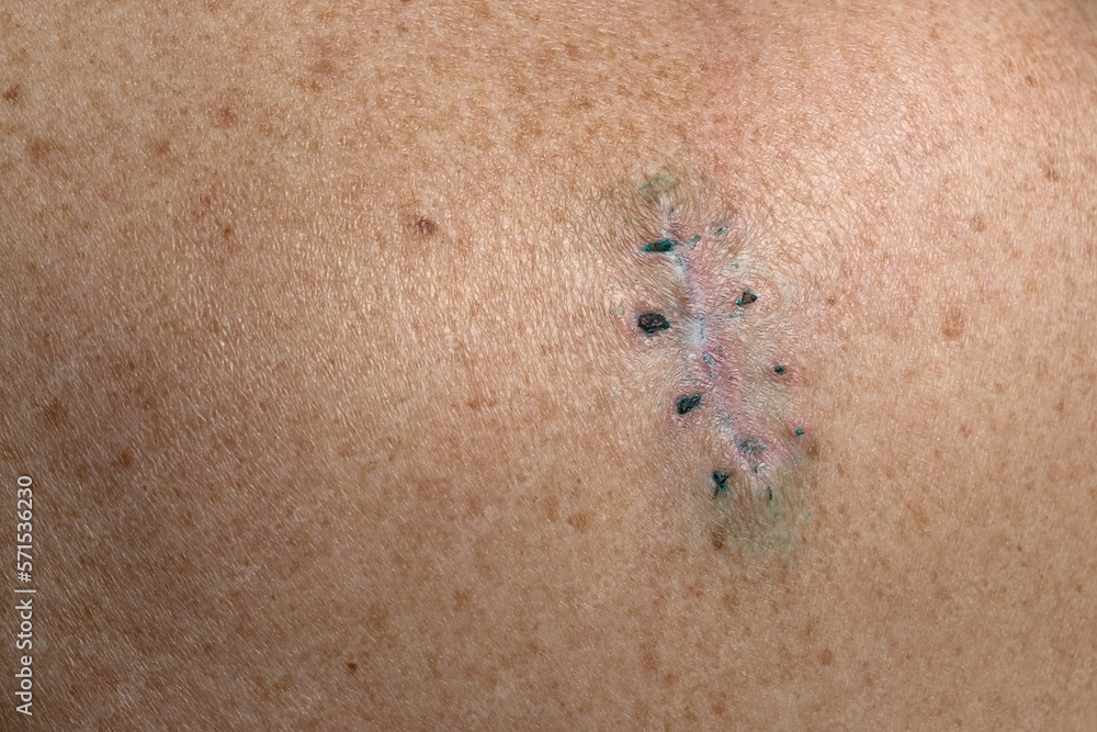 Fototapeta premium Surgical suture on the skin