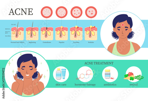 Acne flat vector face skin treatment infographic