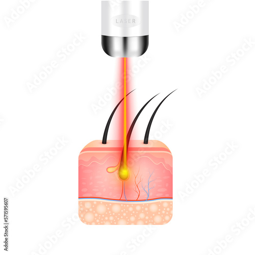 Skin layers anatomy with hairs and yellow laser light hair removal. Unwanted out make skin smooth. Banners are used for beauty advertisements. Medical science concept. File PNG 3D. photo