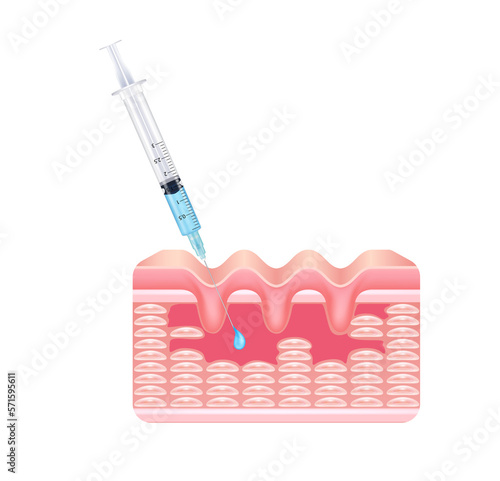 Fotografie Injection filler and botox injection under the skin on face with wrinkle dermal layer