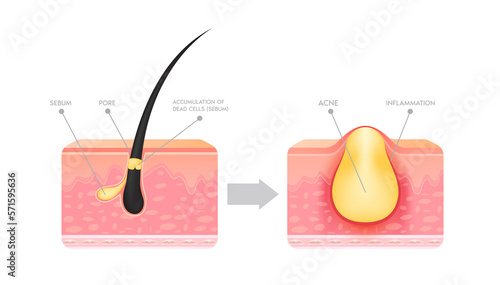 Formation of skin acne or pimple. Accumulation of dead cells and inflammation associated with pimples. The sebum in the clogged pore promotes the growth of a certain bacteria. File PNG 3D. photo