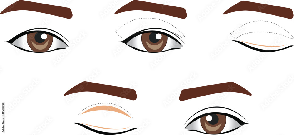 Blepharoplasty of the upper and lower eyelids Blepharoplasty of the upper and lower eyelids