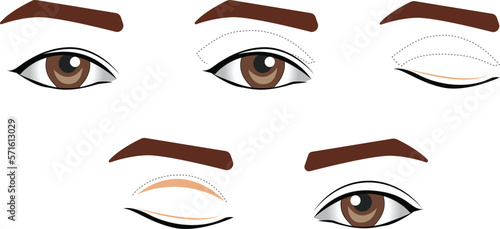 Blepharoplasty of the upper and lower eyelids photo