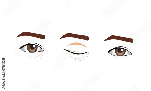 Blepharoplasty of the upper and lower eyelids
