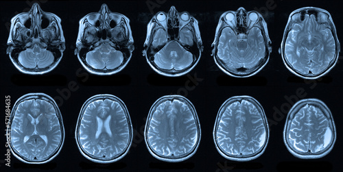 x image of brain. Magnetic resonance imaging of the human head, MRI