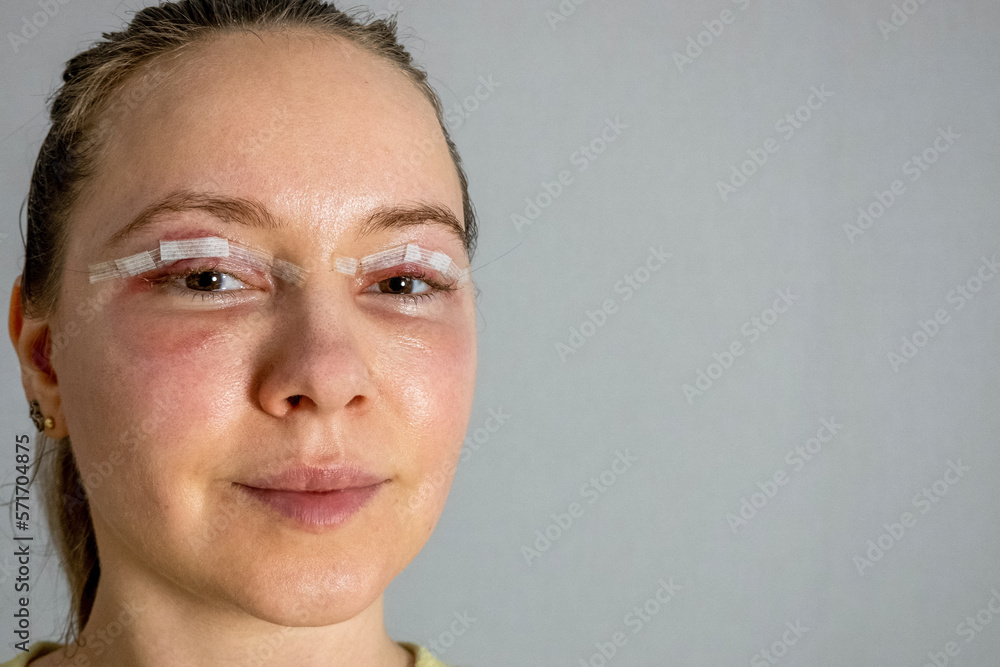 close up woman eyes after plastic surgery, yellow red color skin