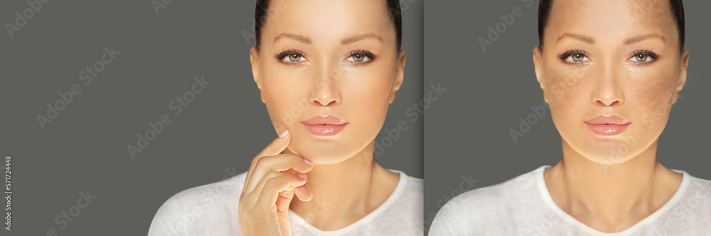 Dark spots, freckles,hyperpigmentation(melasma or chloasma),concept - skin lightening, skin whitening, fruit acids,AHA, Skin Brightening Dark spots, freckles,hyperpigmentation(melasma or chloasma),concept - skin lightening, skin whitening, fruit acids,AHA, Skin Brightening