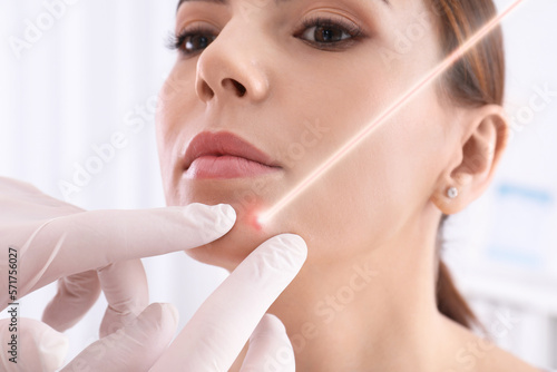 Laser mole removal. Doctor checking patient's skin during procedure in clinic, closeup photo