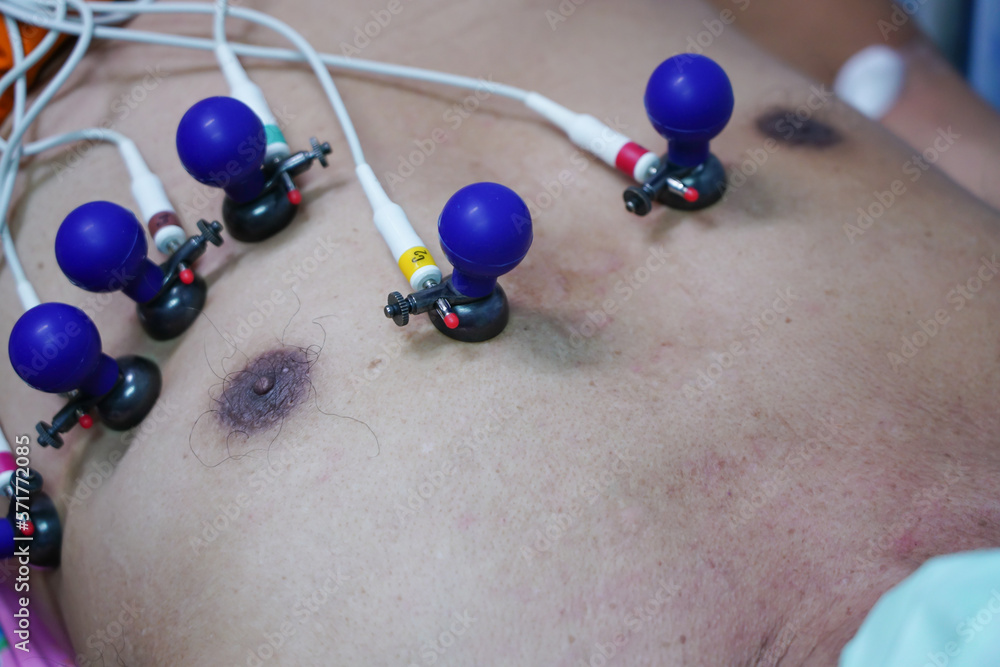 ECG or EKG of man with electrodes for electrocardiogram records on bed
