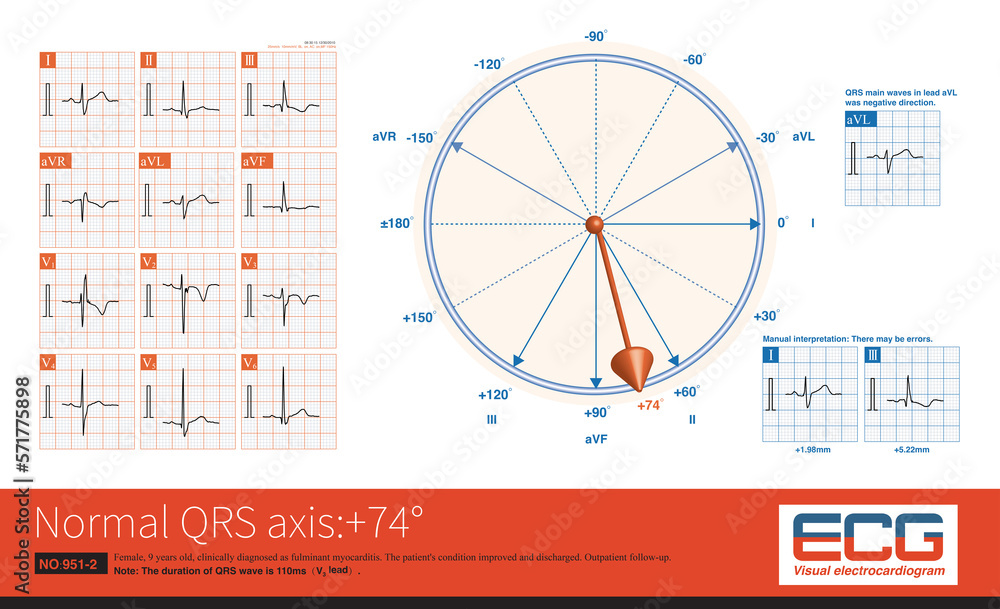 When the frontal QRS axis is located at +74°, the QRS main wave in lead