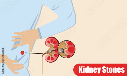 kidney stones disease in flat design
