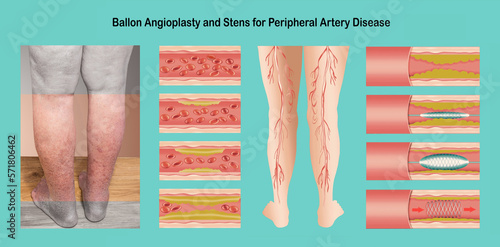 Diagram showing angioplasty for peripheral artery disease illustration photo