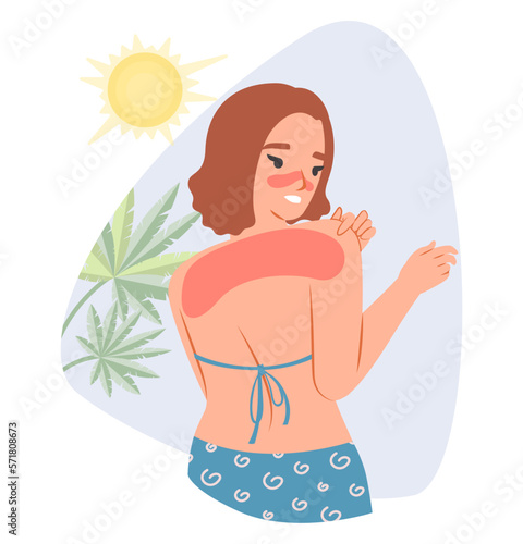 Sunburn vector young woman caring redness shoulder