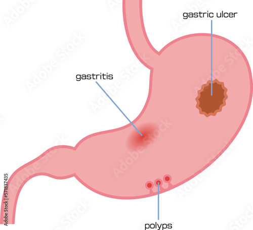 胃炎、胃潰瘍、ポリープを表したイラスト／Illustration showing gastritis, stomach ulcer and polyp