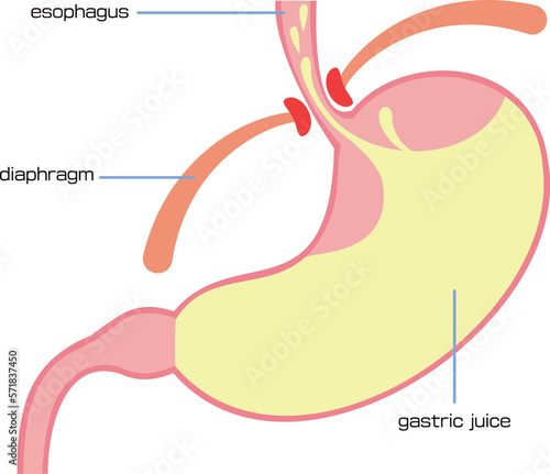 逆流性食道炎を起こしている胃のイラスト／Illustration of stomach causing reflux esophagitis