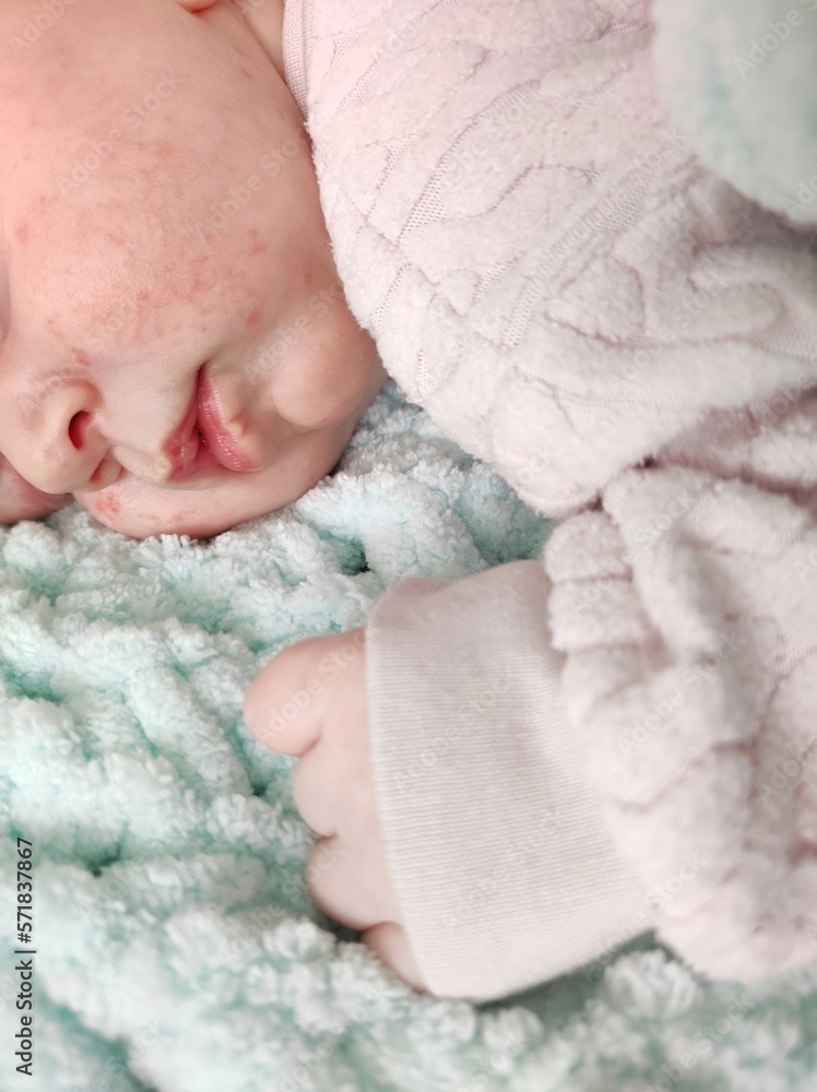 rash on the face of a newborn, a child with a rash on the cheeks lies