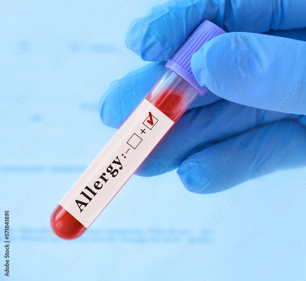 Doctor holding a test blood sample tube positive with allergy test . Doctor holding a test blood sample tube positive with allergy test .