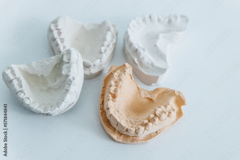 Foto de A cast of teeth. Plaster model of plaster of teeth. Dental