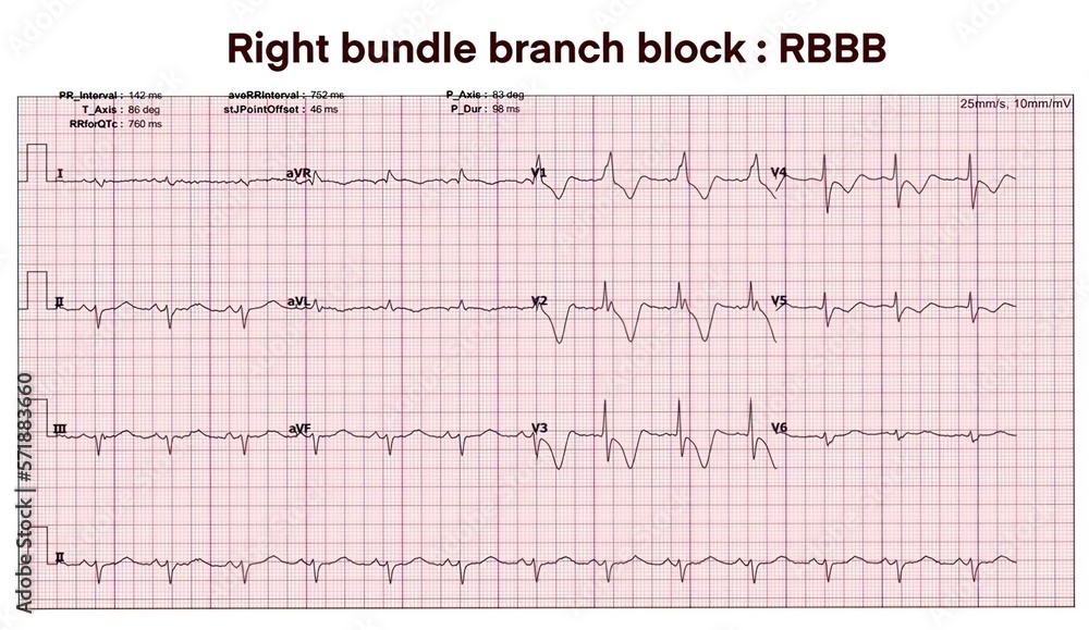 Electrocardiogram show Right bundle branch block. RBBB.Heart beat. CPR. ECG. EKG. Vital sign. Life support. Medical healthcare symbol.