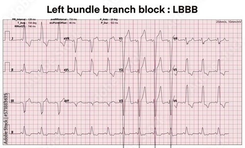 Electrocardiogram show Left bundle branch block. LBBB.Heart beat. CPR. ECG. EKG. Vital sign. Life support. Medical healthcare symbol.