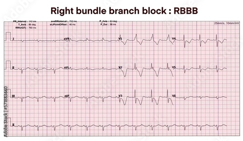 Electrocardiogram show Right bundle branch block. RBBB.Heart beat. CPR. ECG. EKG. Vital sign. Life support. Medical healthcare symbol.