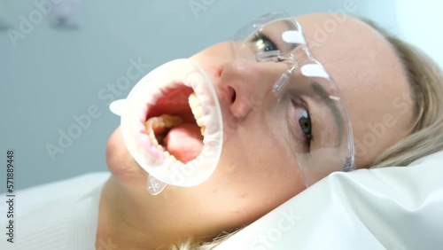 woman in dental chair with retractor on mouth holding lips for dental procedures in transparent glasses opens and closes mouth grimaces making faces smiling cheerful dentistry funny close-up photo