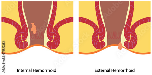 Hemorrhoid illustration. Internal and external hemorroid illustration