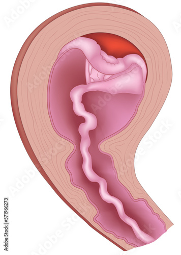 Vector illustration of placental abruption and expulsion.