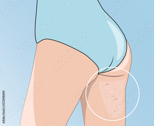 illustration. A woman has cellulite and stretch marks on the skin of her legs, outer and inner thighs. Treatment of skin stretch marks in the clinic