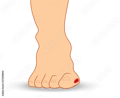 Diabetic foot illustration. Ulcer in the toe