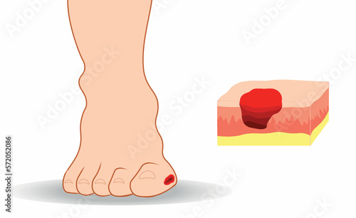 Diabetic foot illustration. Ulcer in the toe and an isolated skin layers  with the ulcer photo