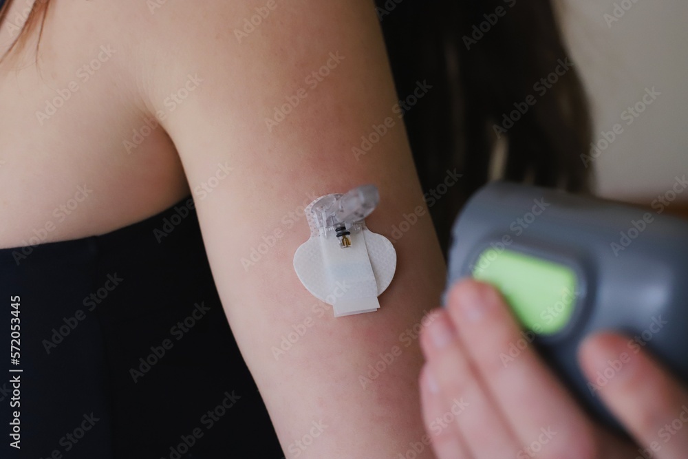Picture of Blood glucose sensor just after insertion with the insertion device ...