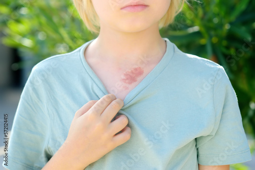 Mark on the skin of chest of eight years old child. Hemangioma is a red birthmark from blood vessels on the skin, benign tumor. photo